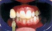 BriteSmile Blanchiment des dents