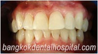 BriteSmile Blanchiment des Dents - Avant