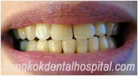 BriteSmile Blanchiment des Dents - Avant