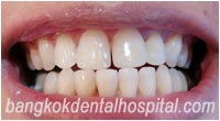 BriteSmile Blanchiment des Dents - Aprs