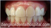 BriteSmile Blanchiment des Dents - Avant