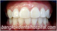 BriteSmile Blanchiment des Dents - Aprs