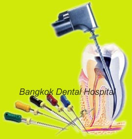 endodontie ou traitement de canal radiculaire