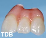 NobelRondo Zirconia Gingiva - before