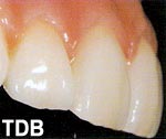 NobelRondo Zirconia Gingiva - after