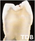 NobelRondo thailand - natural premolar - reflected and UV-light