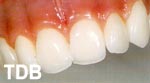 NobelRondo Zirconia sur Procera Zirconia Bridges
