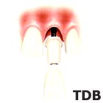 Solution premium avec NobelSpeedy Groovy avec 
      Procera Abutment et Procera Crown