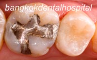 dentisterie opératoire restaurations avant