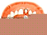 teeth-in-an-hour in dental thailand