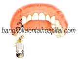 teeth-in-an-hour in dental bangkok